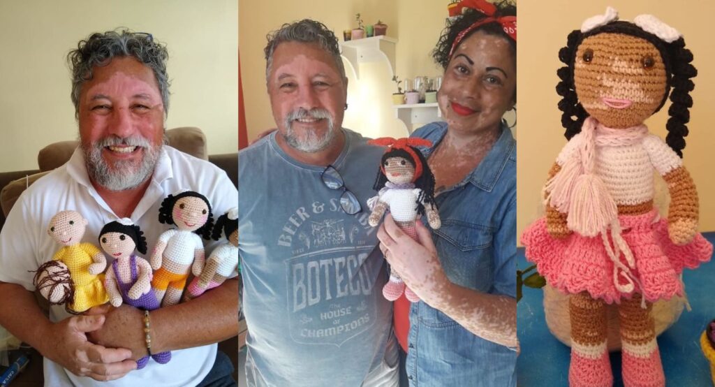 “A grandfather with vitiligo, crochets beautiful dolls for children.”